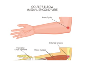 Viêm gân ở khuỷu tay (Golfer’s Elbow ) ở người chơi Golf. 